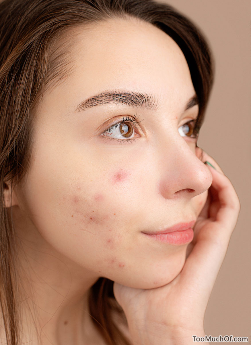 acne-on-face